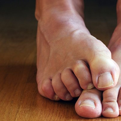 Toenail Fungus is Doomed... New Treatment Discovered!