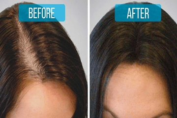 Safest & Fastest Hair Loss Treatment